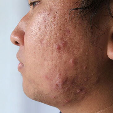 teenager with acne