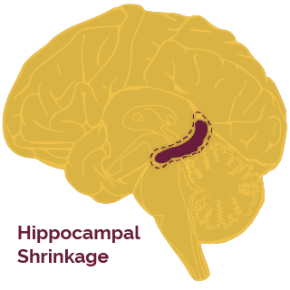 Hippocampal shrinkage from insulin resistance in Alzheimers
