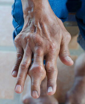 gout in a hand